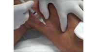 Varizes e varicoses: Escleroterapia para varicoses