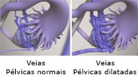 Varizes pélvicas